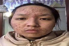 健康之路痘痘视频最新